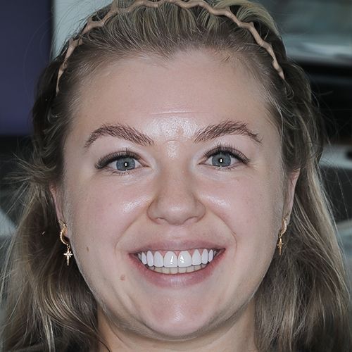 Composite veneers - after - Shannen - 3dental